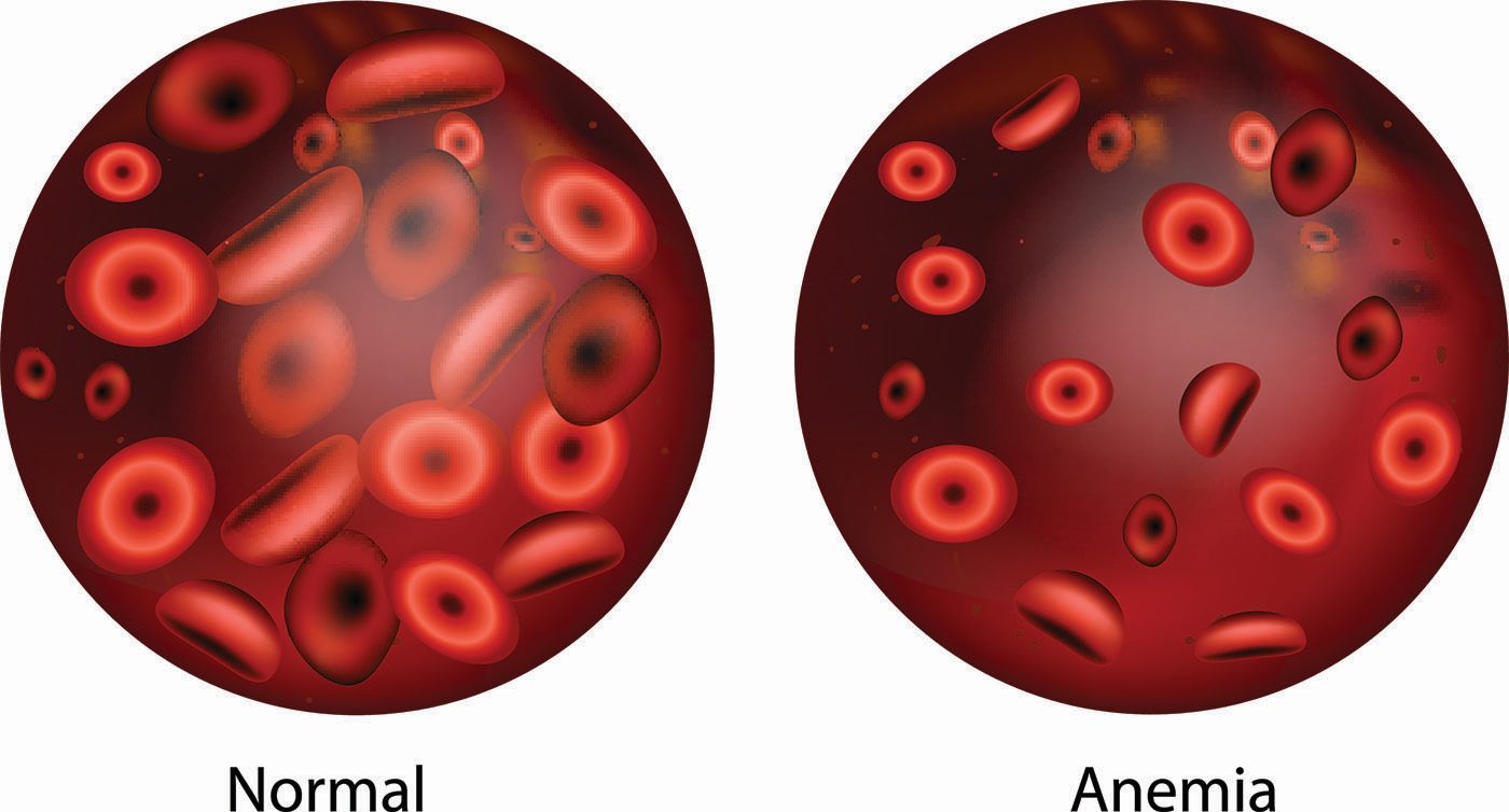 anemia simptome